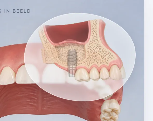 3D-Illustration der oberen Zahnreihe mit vergrößerter Schnittansicht von Kieferhöhle, Knochen und Implantat